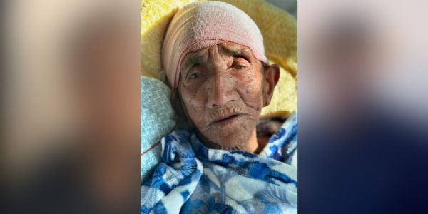 नेपालदेशे १०३-वर्षीया वृद्धाया: मस्तिष्कस्य सफलं शल्यक्रिया सम्पन्ना