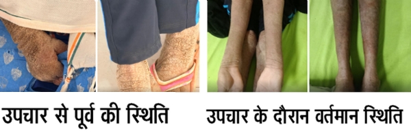 बच्ची की पहले और उचार के बाद की स्थिति बच्ची की पहले और उचार के बाद की स्थिति